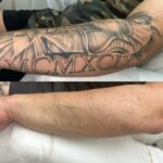 Master Class in Advanced Tattoo Removal